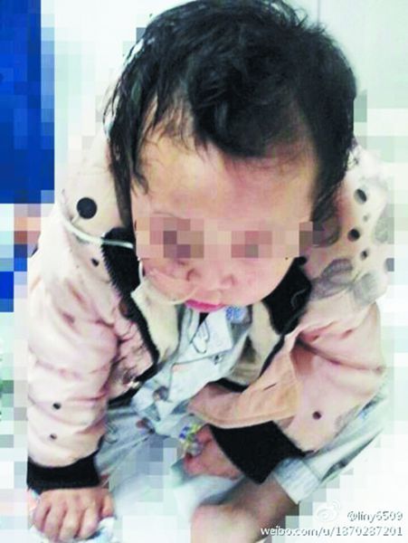 4岁女童浑身伤痕食管破裂疑遭母亲家暴