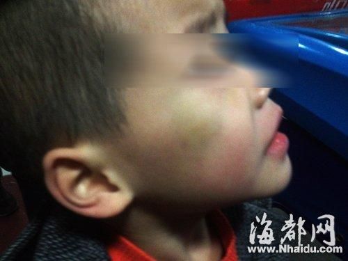 4岁儿童在幼儿园被老师殴打班主任称无可奉告