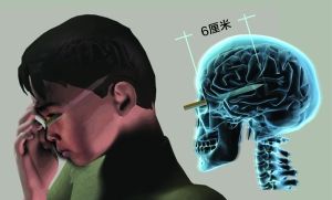 男童摔倒致眼睛被笔戳入6厘米肿似半个乒乓球